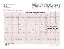 Cardea Ecg Library Cardiac Insight